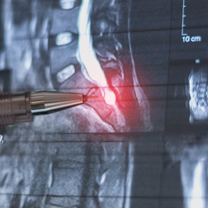 Medical X-ray showing a spinal condition with a red highlight on the vertebrae.