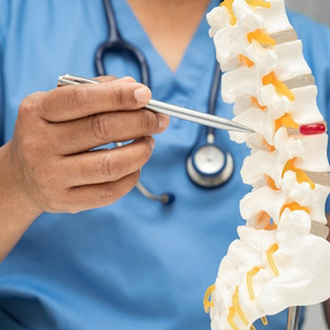 A healthcare professional pointing to a herniated disc on a spinal column model.