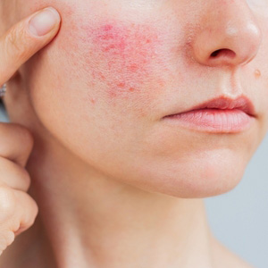 Close-up of a person touching a red skin rash on their face for a medical claim.