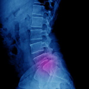 An X-ray of the human spine highlighting a displaced vertebra and lower back pain.