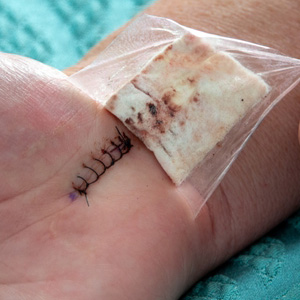 Close-up of a surgical incision on a wrist following carpal tunnel treatment.