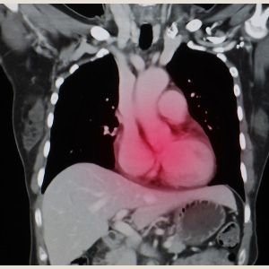 A medical chest X-ray with the heart area highlighted in red to show heart disease.