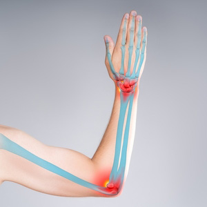 Illustration of a human arm highlighting nerve pathways for a medical claim.