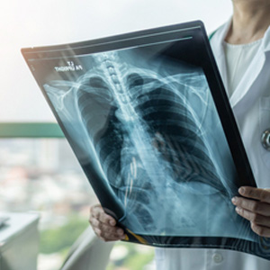 A medical professional examining a chest X-ray for a lung disease disability claim.