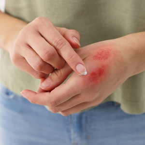 A person examining red burn marks on their hand for a medical disability claim.