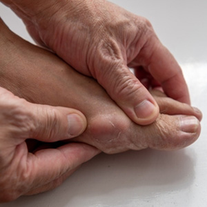 Close-up of hands examining a swollen, painful toe joint representing gout symptoms.