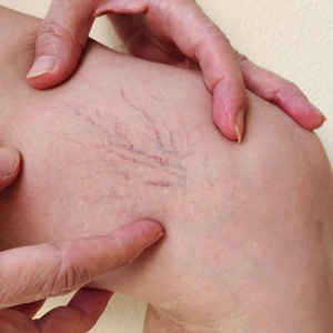 Close-up of a person's leg showing visible red blood vessels and skin inflammation.