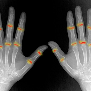 X-ray of human hands with orange highlights on finger joints for a disability claim.