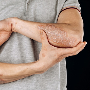 A person examining a scaly skin patch on their elbow for a disability evaluation.