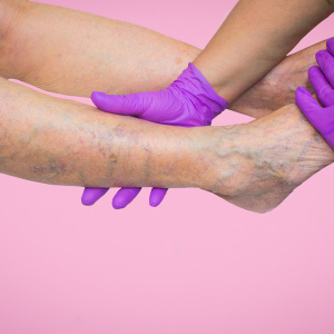 A medical professional in purple gloves examining varicose veins on a patient's leg.