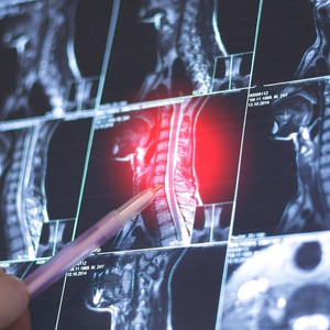 Doctor pointing to a red inflammation area on a spinal X-ray for a disability claim.