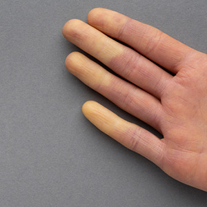Close-up of fingers showing characteristic skin discoloration from Raynaud's disease.